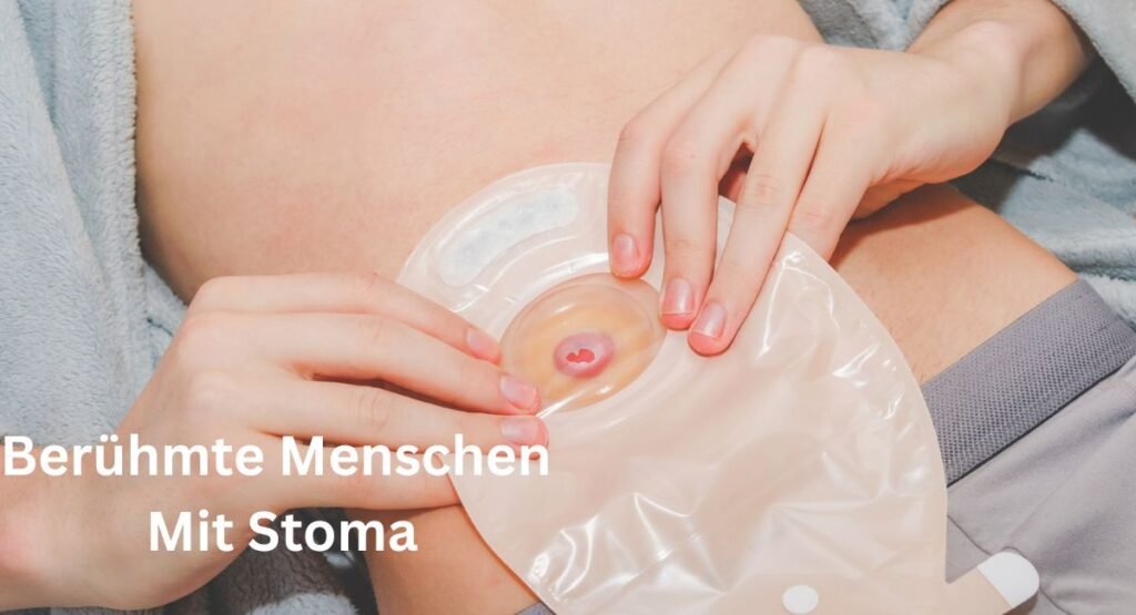 berühmte-menschen-mit-stoma